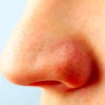 nose
